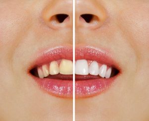 TEETH WHITENING OR BLEACHING